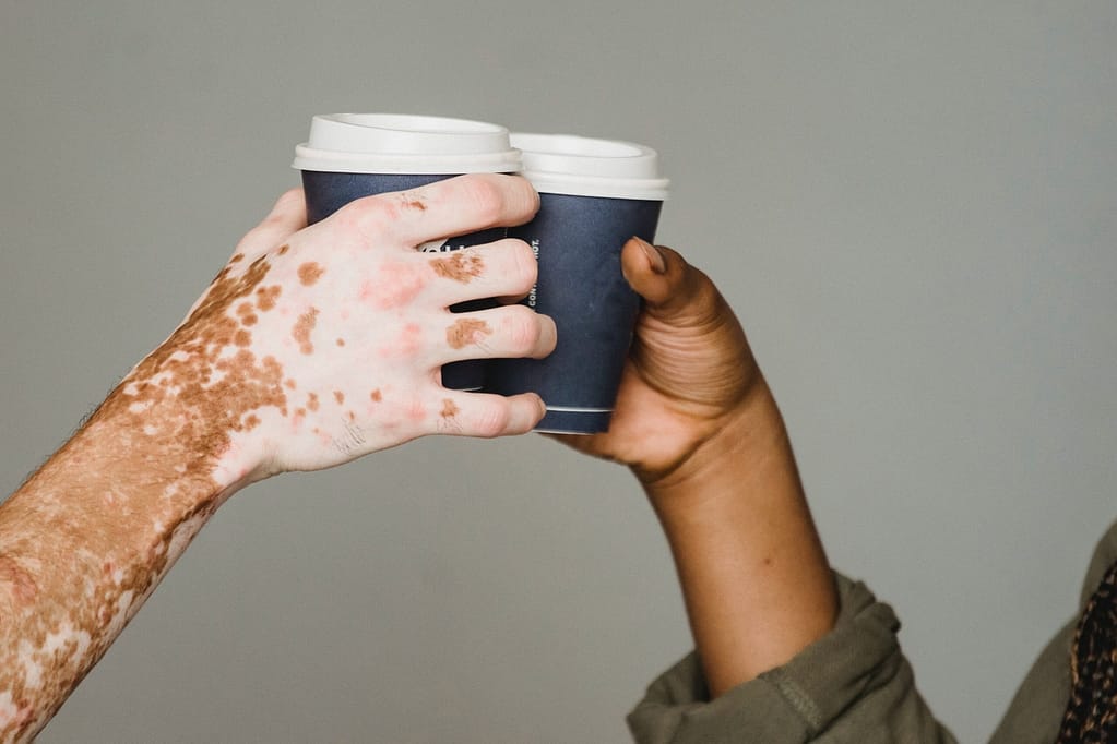 how fast does vitiligo spread
