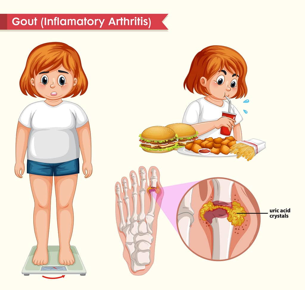 Scientific medical illustration of gout concept illustration