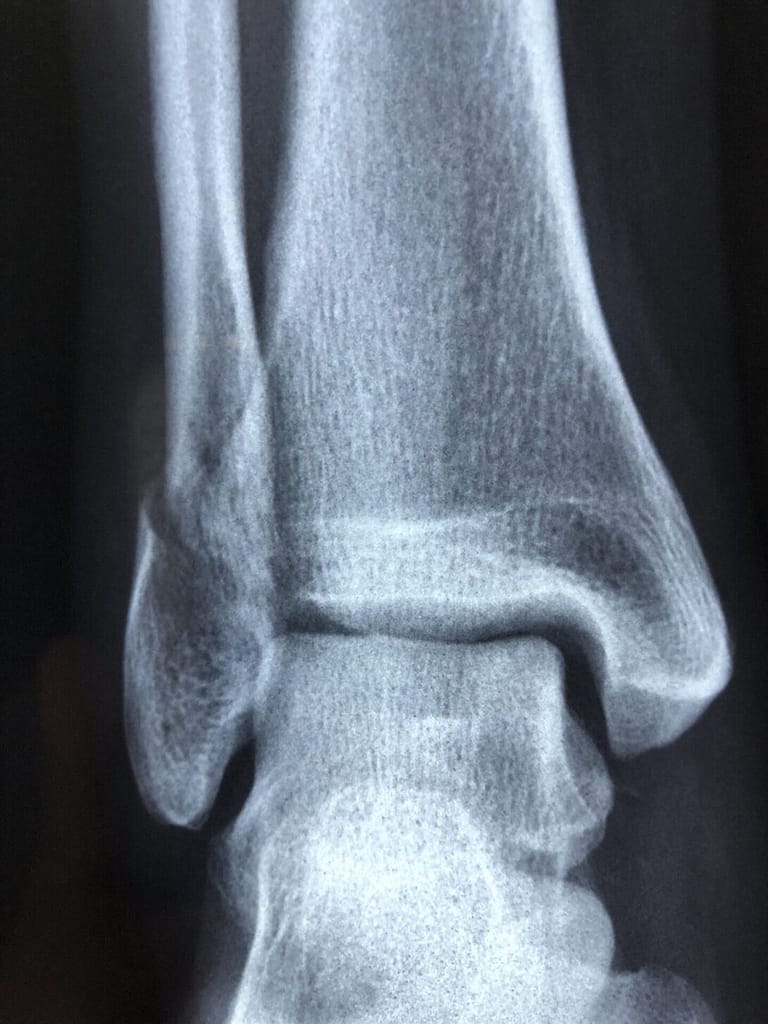 ankle sprain x-ray